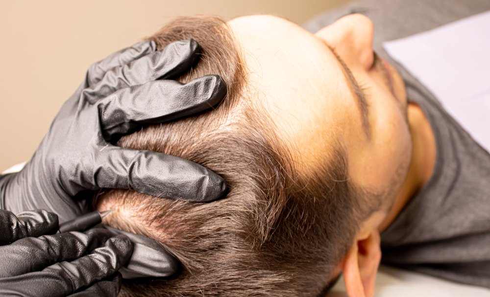 Exploring the Efficacy of PRP Hair Restoration: Is it Really a Success Story?